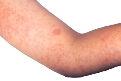 Measles