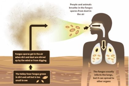Valley Fever