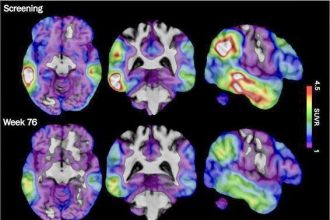 Experimental Alzheimer's Drug. These brain scan images provided by Biogen show how high levels of Alzheimer's-related tau protein, in red, dropped in a recipient of the company's experimental drug diranersen.  Credit: Biogen via AP