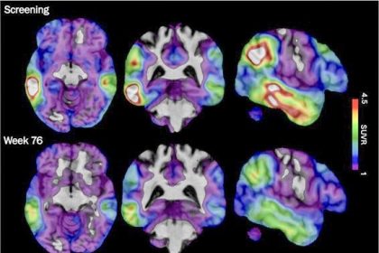 Experimental Alzheimer's Drug. These brain scan images provided by Biogen show how high levels of Alzheimer's-related tau protein, in red, dropped in a recipient of the company's experimental drug diranersen.  Credit: Biogen via AP