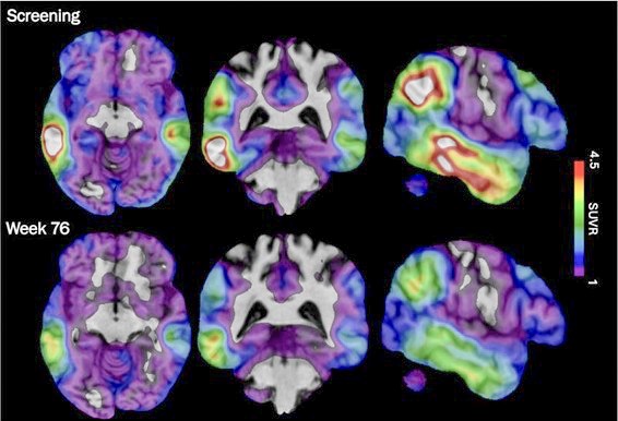 Experimental Alzheimer's Drug. These brain scan images provided by Biogen show how high levels of Alzheimer's-related tau protein, in red, dropped in a recipient of the company's experimental drug diranersen. Credit: Biogen via AP